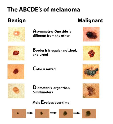 show me a picture of a mole|Melanoma Skin Disorder: Pictures, Causes And Symptoms